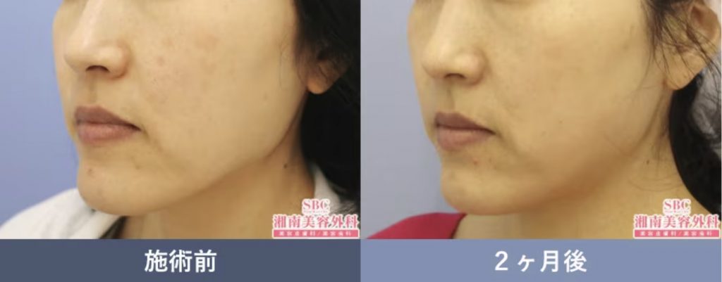 湘南容皮膚科 レーザートーニングの症例