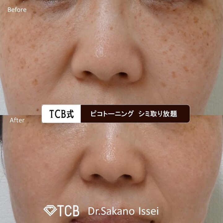 TCB東京中央美容外科 梅田大阪駅前院のシミ取りレーザーの症例