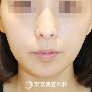 東京美容外科のシミ取りレーザーの症例