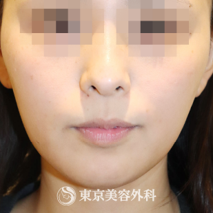 東京美容外科のシミ取りレーザーの症例