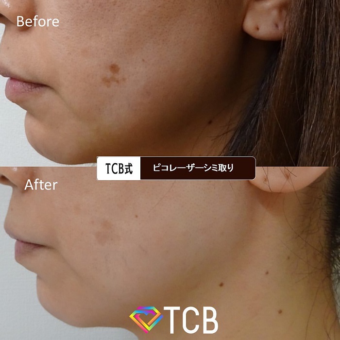 TCB東京中央美容外科のシミ取りレーザーの症例