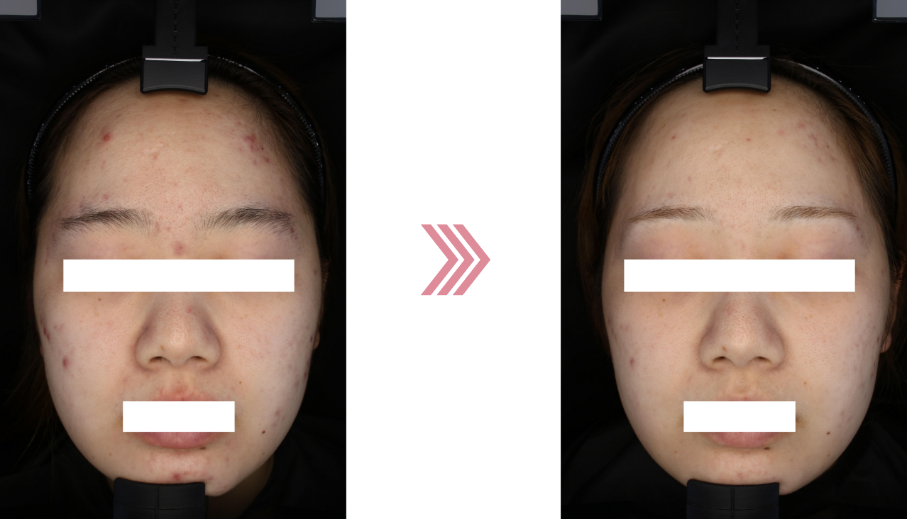 アレキレーザーの治療前後の写真2ヶ月後