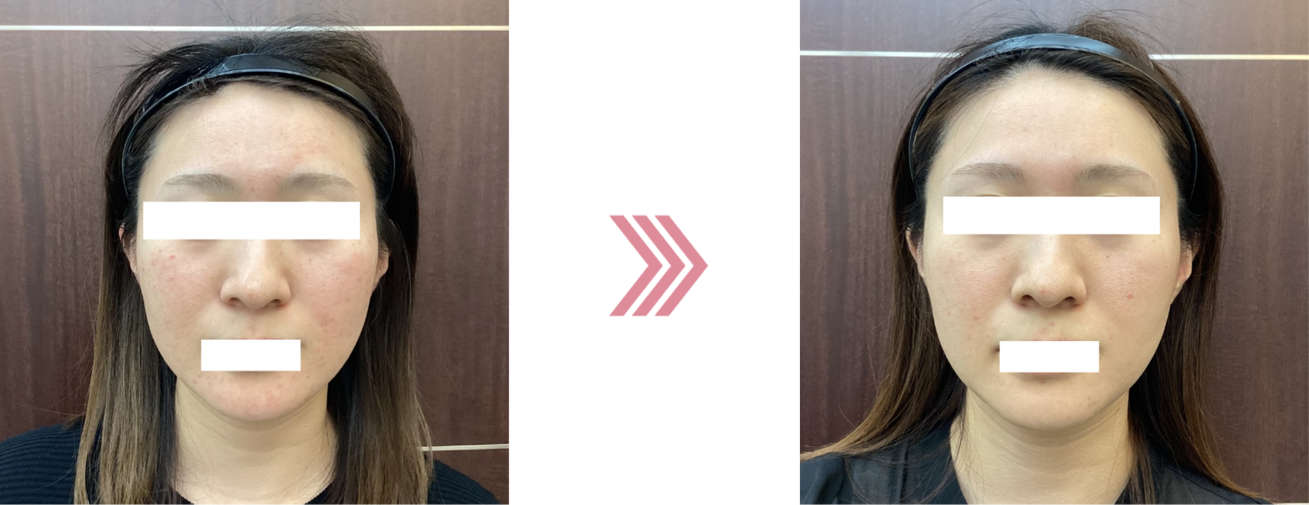 アレキレーザーの治療前後の写真5ヶ月後