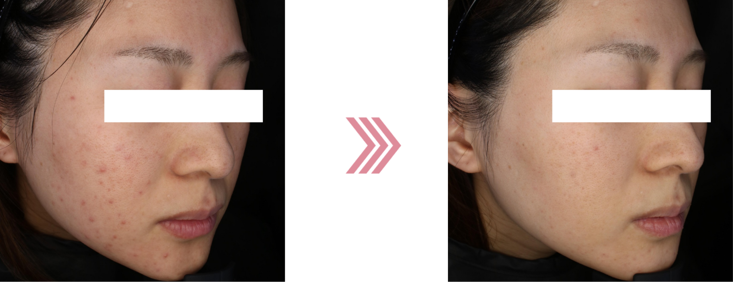 クライオポレーションの治療前後の写真6ヶ月後