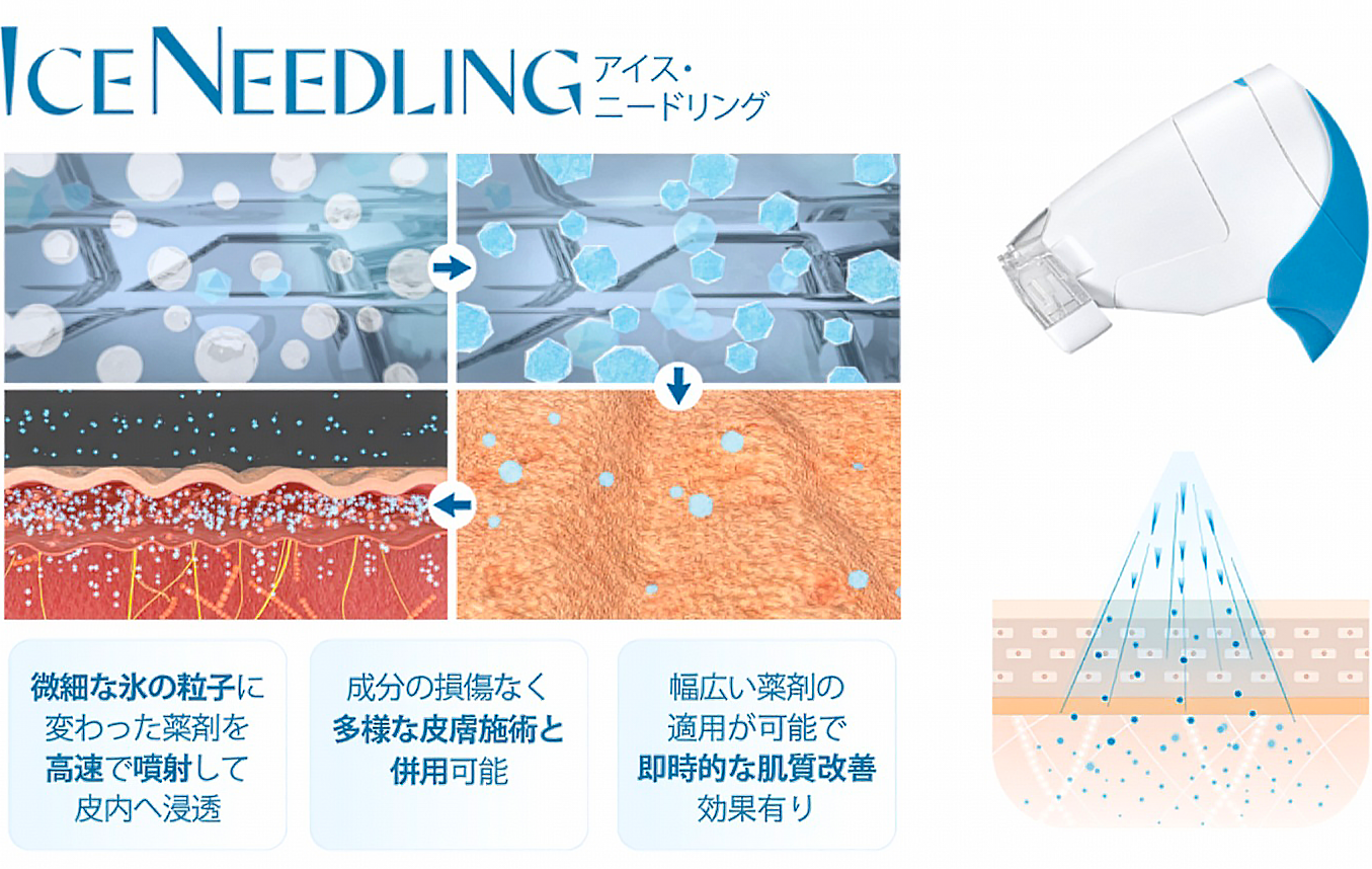 アイスニードリングの医学的なメカニズムの図