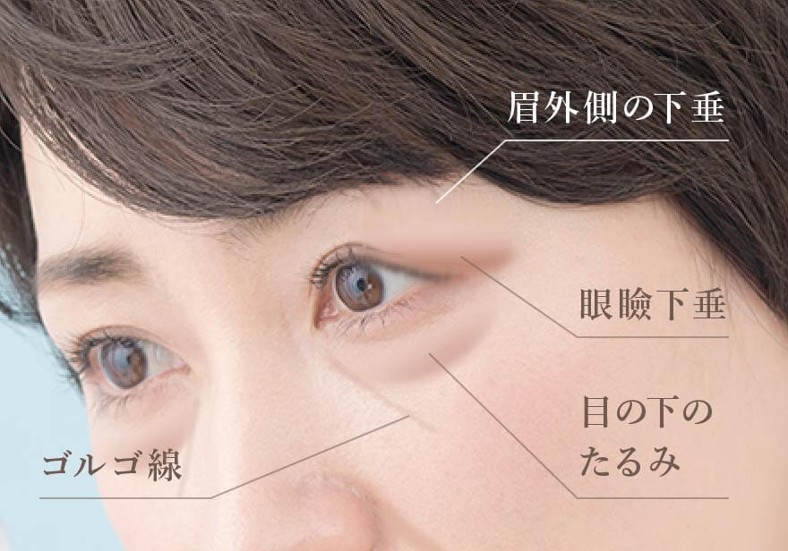 熊本で眉外側の下垂やゴルゴ線、眼瞼下垂、目の下のたるみでお悩みの女性のイメージ画像
