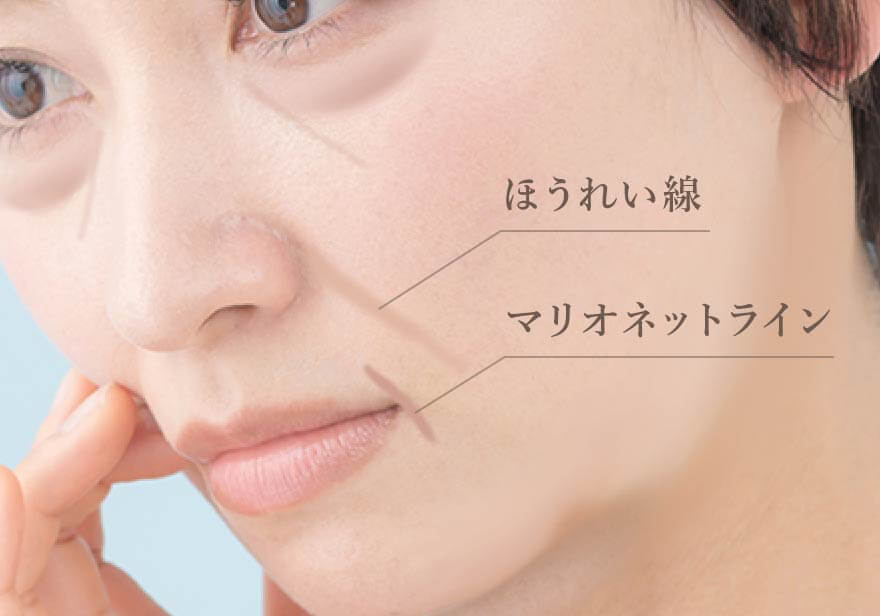 熊本でほうれい線やマリオネットライン、ブルドッグ顔でお悩みの女性のイメージ画像
