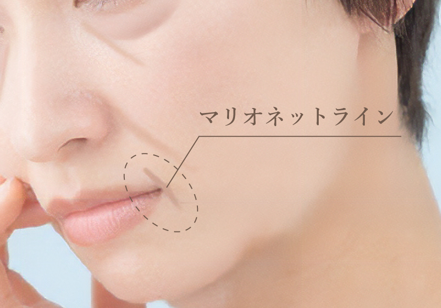 マリオネットラインのイメージイラスト画像